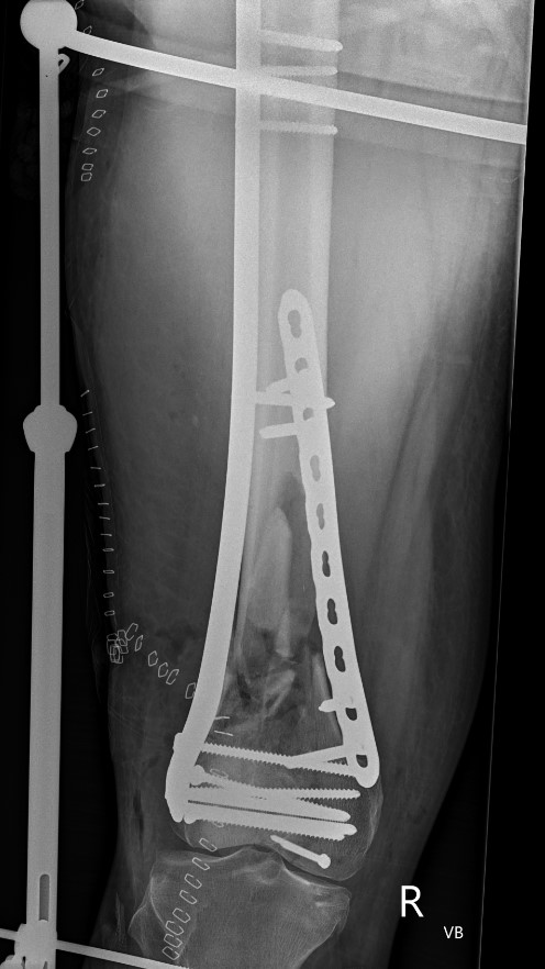 Femur dual plate 1